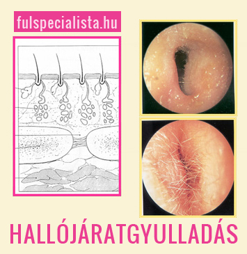 HALLÓJÁRAT GYULLADÁS (otitis externa)