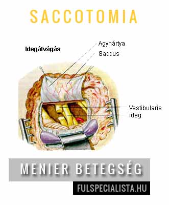 menier saccotomia fülműtét