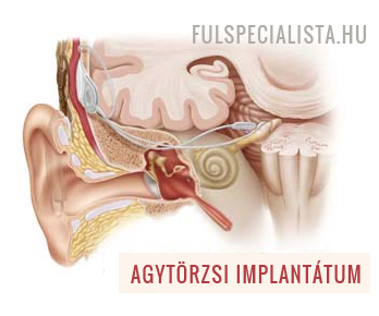 agytörzsi implantatum hallásjavítás