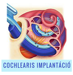 cochlearis implantáció hallás segítő műtét