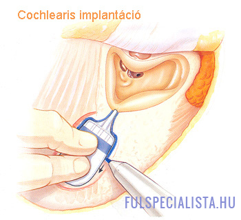 cochlearis implantacio fülműtét