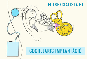 cochlearis implantacio műtét