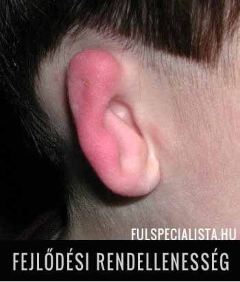 fül fejlődési rendellenesség fülműtét fülplasztika