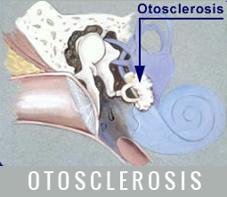 otosclerosis műtét hallás helyreállító műtét