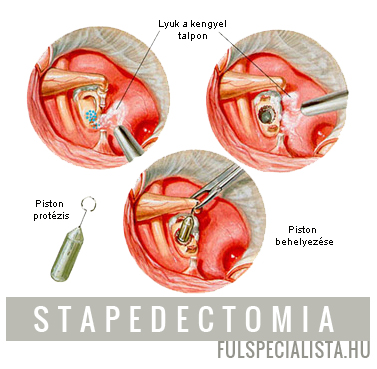 stapedectomia piston protezis fülműtét halláscsökkenés miatt