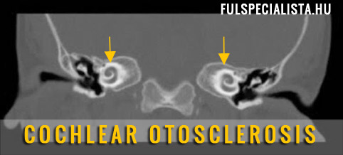 COCHLEAR OTOSCLEROSIS fül röntgen CT vizsgálat