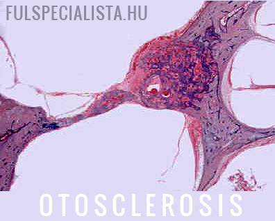 otosclerosis szövettan műtéti megoldas
