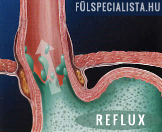 reflux fájdalom feljövő gyomorsav túltengés gyomorégés
