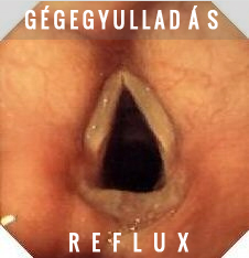 reflux gégegyulladás  köhögés folytó érzés krákogás