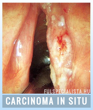 carcinoma in situ gége rekedtség, krákogás dohányzás