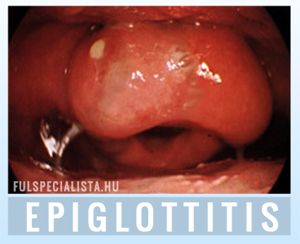 epiglottitis gégegyulladás hangszalaggyulladás köhögés