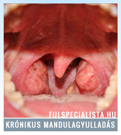 A mandula a dohányzás miatt fáj, Hogyan kezelhető a visszatérő mandulagyulladás?