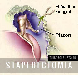hallásjavító fülműtét stapedectomia