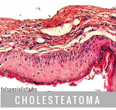 cholesteaoma otitis középfülgyulladás