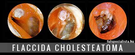 flaccida cholesteatoma fülfolyás középfülgyulladás