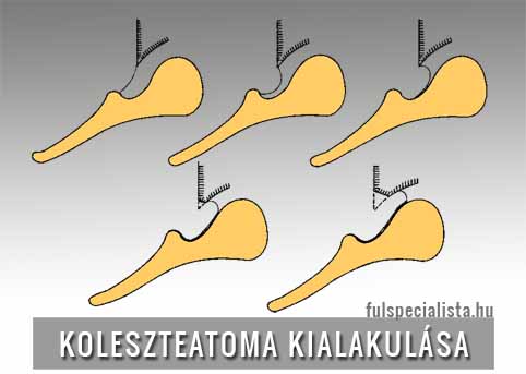 koleszteatoma kialakulasa fülfolyás
