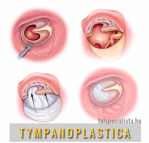 középfülgyulladás tympanoplastica timpanoplasztika fülműtét