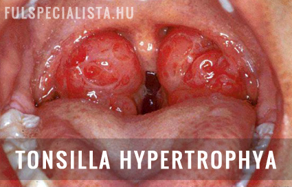 gyulladt tonsilla hypertrophia megnagyobbodás