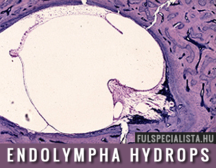 endolympha hydrops Menier, szédülés kezelés
