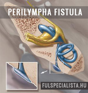 perilympha fistula szédülés