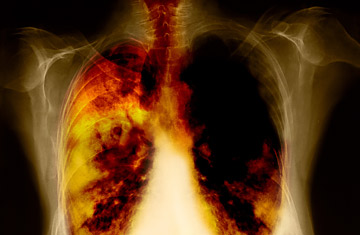 a dohányzás által okozott légzőszervi betegségek)