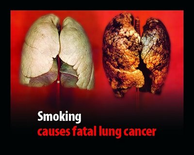 dohányzás és tüdőrák elvette és csak leszokott a dohányzásról