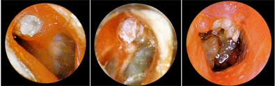 koleszteatóma diagnosztika jelek Schüller röntgen felvétel koleszteatóma üreg vénák sinus sigmoideus trombózis  Stenvers röntgen felvétel egyensúly szerv hallójárat szövődmény hallásvizsgálat halláskárosodás, belsőfül károsodás kevert jellegű halláscsökkenés romló idegi halláskárosodás teljes megsüketülés neuritis neuronitis statoacustica arcidegbénulás arcideg zsába faciál parézis