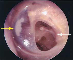 fül mikroszkópos képe dobhártya közepén lyuk Akut fülfolyás polipok fülben váladék nyákos, vagy nyákos gennyes, szagtalan. A röntgen leleten (Schüller-felvétel) a csecsnyúlvány légtartalmának a gátoltsága látható Hallásvizsgálattal vezetéses vagy kevert jellegű halláskárosodás mutatható ki