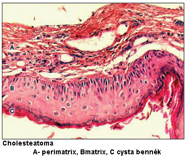 koleszteatóma nyomás pusztul koleszteatóma befertőződik anaerob rothasztó baktériumok, bűzös a váladék koleszteatóma szövődmény agytályog gyulladás hámdaganat enzimek collagenase kollagenáz koleszteatóma nyomása csont pusztulás koleszteatóma szövődmény műtét gennyes folyamatot szövődmények veszélye agyi tályog radikális fülműtét hallócsontok elpusztulnak hallás nagyfokú romlása koleszteatóma képződés