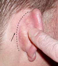 Elálló fül  Kezelése fül deformitás fül deformitás gyermekkorban személyiségfejődési zavarok oka gátlásosság, szorongás, visszahúzódás. műtéti megoldás esztétikai műtét látványos pszichológiai változás fülplasztika fül korrekció érzéstelenségét, érzékenység. fülplasztika fül korrekció Szeged fülész fülplasztikus füldeformitások. a légycsapó fül denevérfül. Műtéti megoldás fülcimpa hasadék fülbevaló fül lenövés fülplasztika fül korrekció korrigáció.