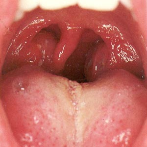 Tonsillitis krónikus prosztatitis