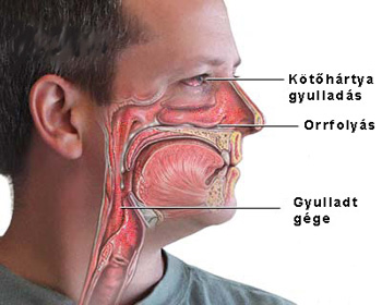 Fog eredetű arcüreg gyulladás kóros szag orrváladék gyerek arcüreg ekcéma arcüreg-gyulladáshoz gyakran társulhat kötőhártya gyulladás köhögés rekedtség bronchitis levertség, kedvetlenség