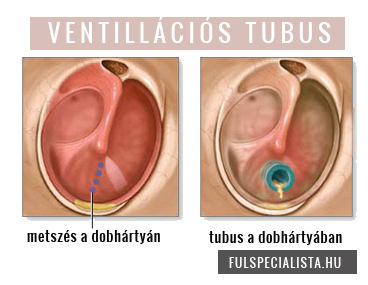 ventillácios tubus savós középfülgyulladás fülkürthurut kezelésére