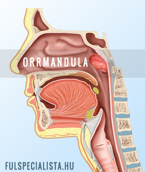orrmandula, orrgarati mandula adenoid orrdugulás horkolás