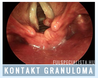 kontakt granuloma kontact ulcus után rekedtség