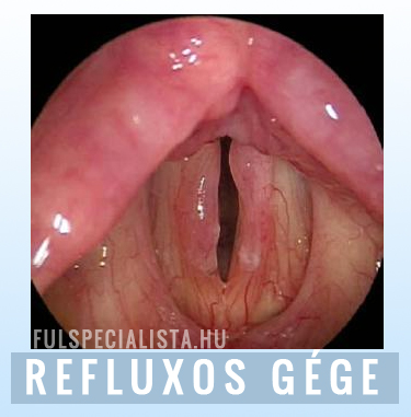 reflux gégegyulladás  köhögés
