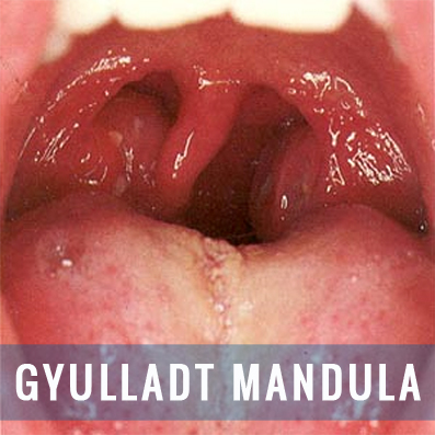 Szimpatika – A rettegett mandulagyulladás